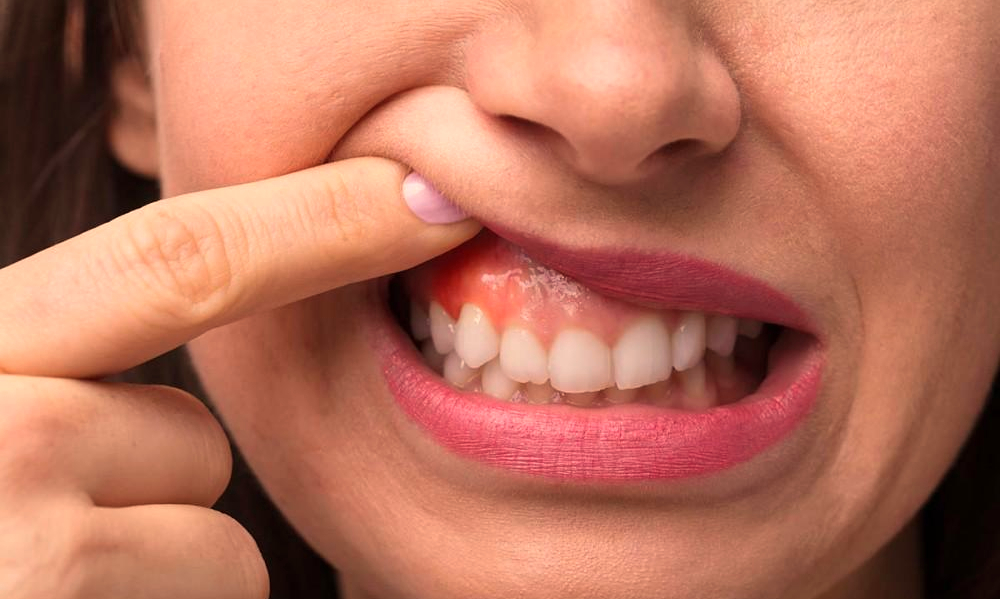 periodontitis-dlesen.jpg
